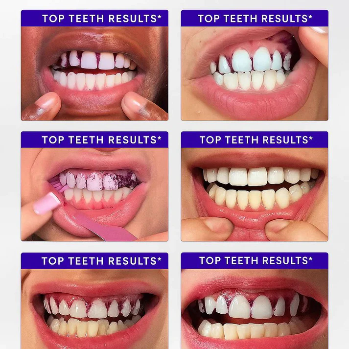 Purple Whitening Strips